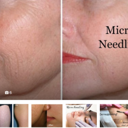 Microneedling